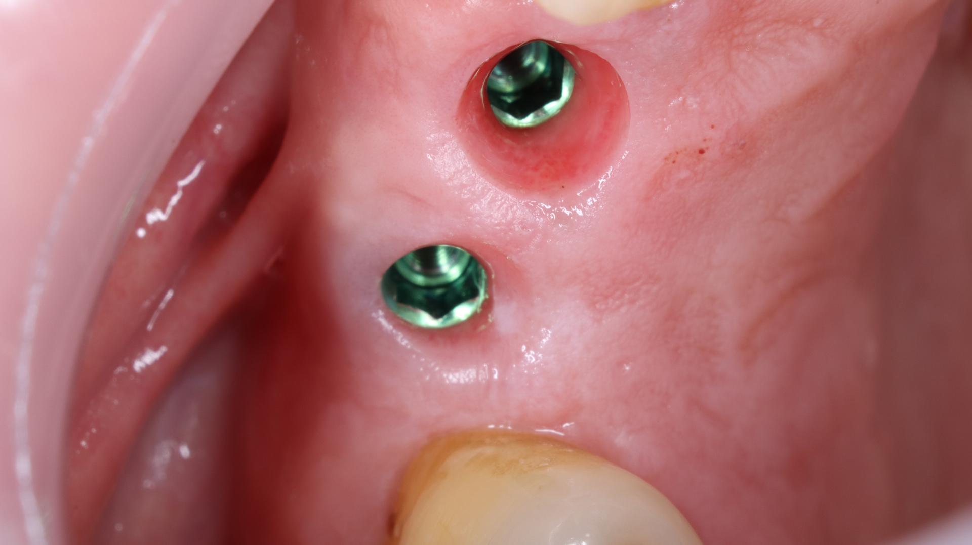 Paso 1 — Implantes colocados (fase inicial)