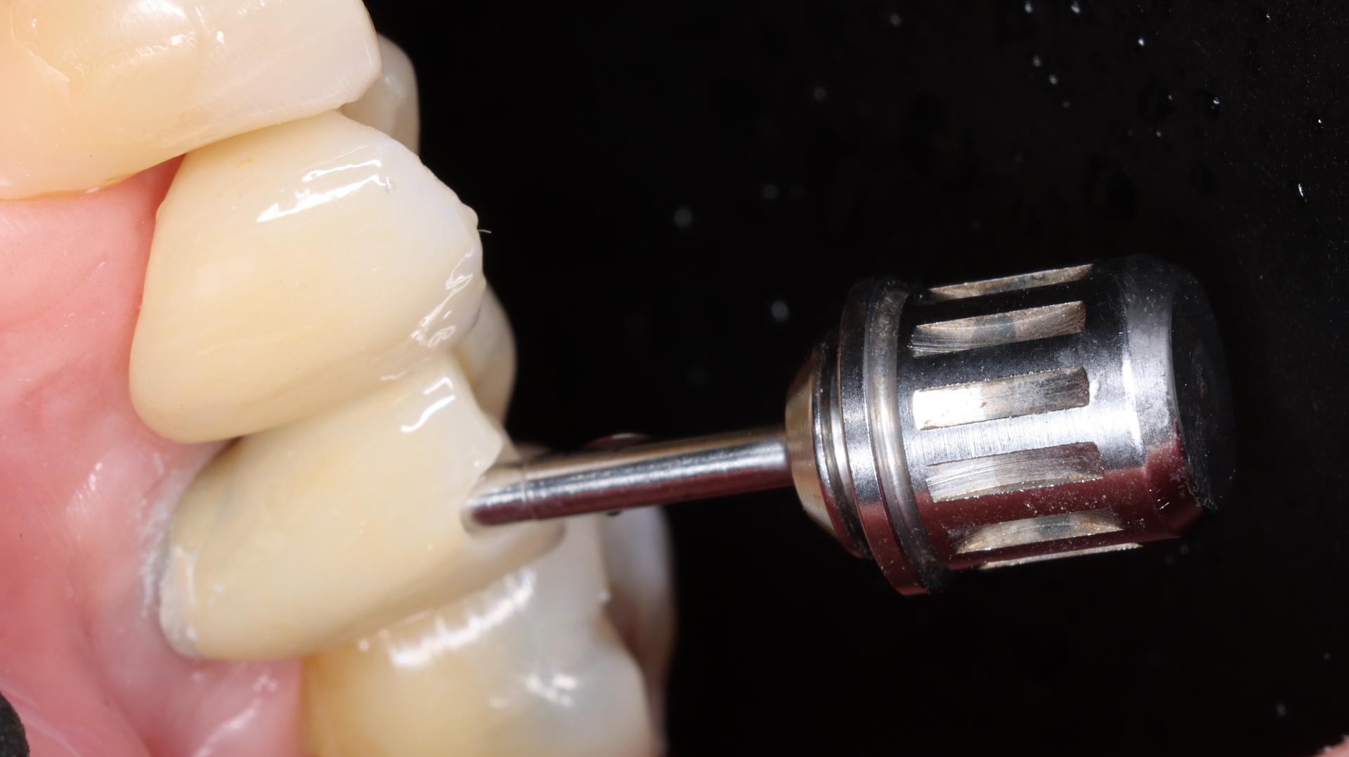 Paso 4 — Ajuste oclusal