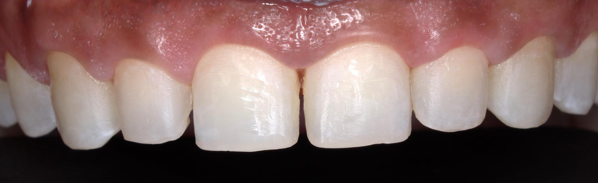 Antes — Restauración estética anterior